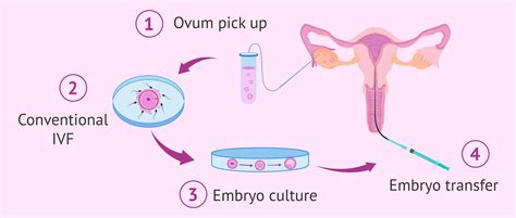 Schéma procesu IVF s imunologickými vstupmi