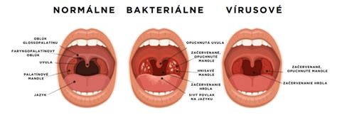 Hnisavá angína u 14-ročného dieťaťa: príznaky, liečba a prevencia