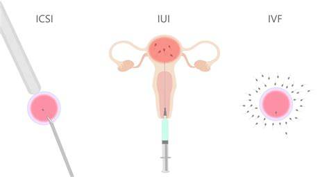 Infografika: Rozdiely medzi IUI, IVF a ICSI