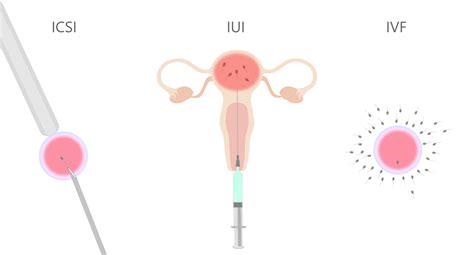Infografika: Prehľad postupov asistovanej reprodukcie (IVF, ICSI, IUI, PGD/PGT)