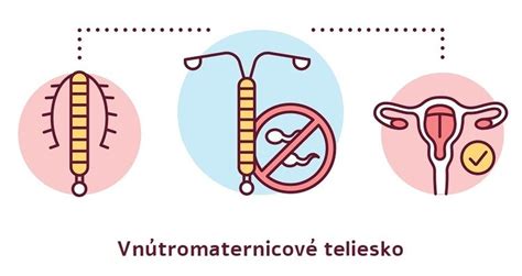 Schematické znázornenie zavedenia vnútromaternicového telieska