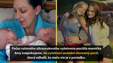 Keď jedno z dvojčiat zomrie počas tehotenstva: Príbeh Ivany a výzvy poľského interrupčného zákona