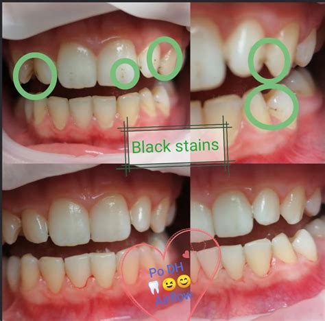 Čierne škvrny na detských zuboch: Príčiny a riešenia