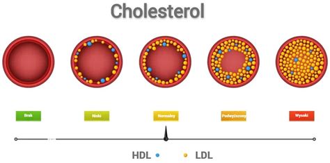 Rozdelenie cholesterolu na LDL a HDL