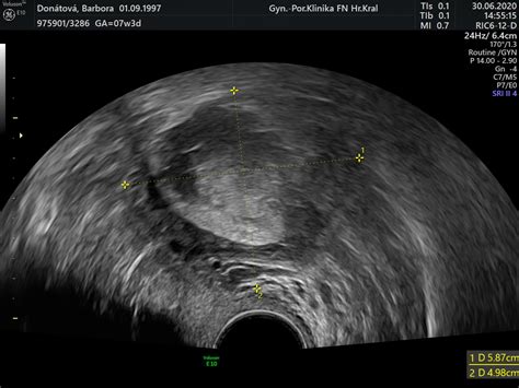 Transvaginálny a transabdominálny ultrazvuk