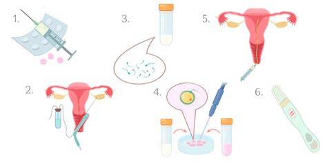 Infografika: Krok za krokom IVF proces