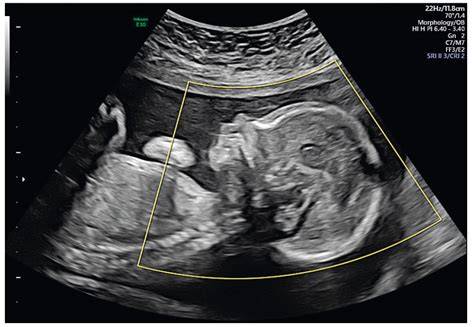 Morfologický ultrazvuk plodu: priebeh a význam, vrátane genetického rozšírenia