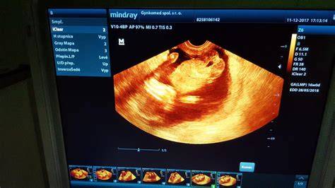 Morfologický ultrazvuk v 17. týždni tehotenstva a súvisiace témy